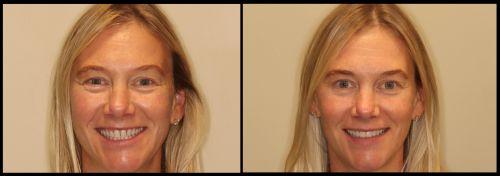 before and after veneers