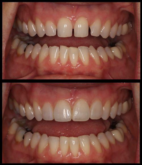 composite veneers before and after results